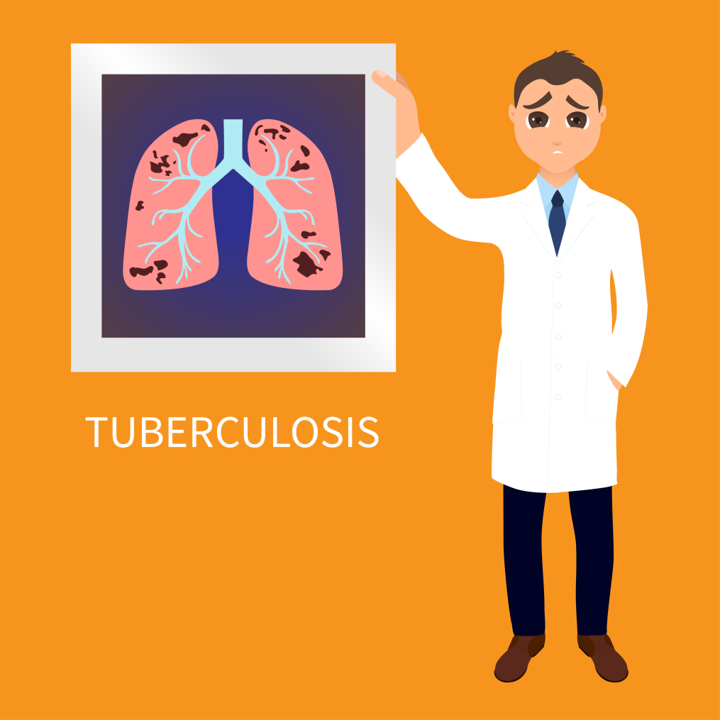 Complete Guide to Tuberculosis Causes, Symptoms & Treatment Complete Guide to Tuberculosis Causes, Symptoms & Treatment