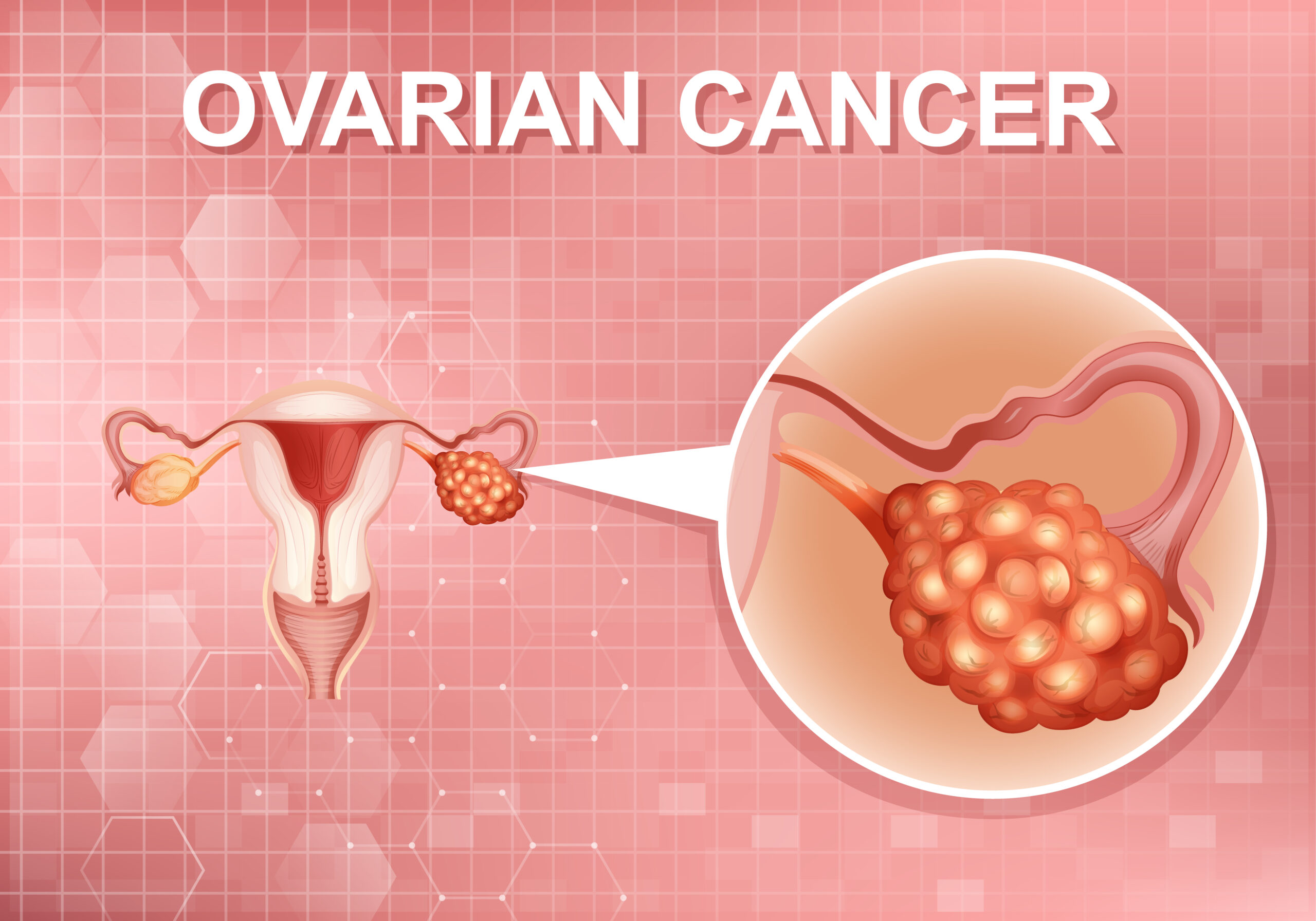 Ovarian Cancer Types: What You Should Know