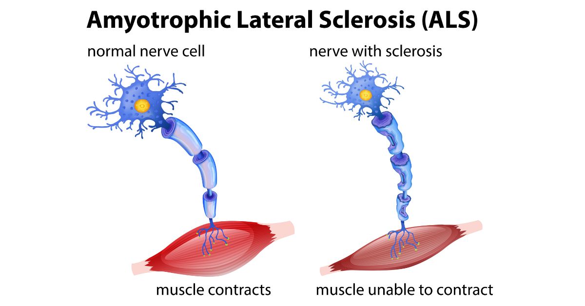 Amyotrophic Lateral Sclerosis (ALS): Types, Causes, Symptoms, Treatment