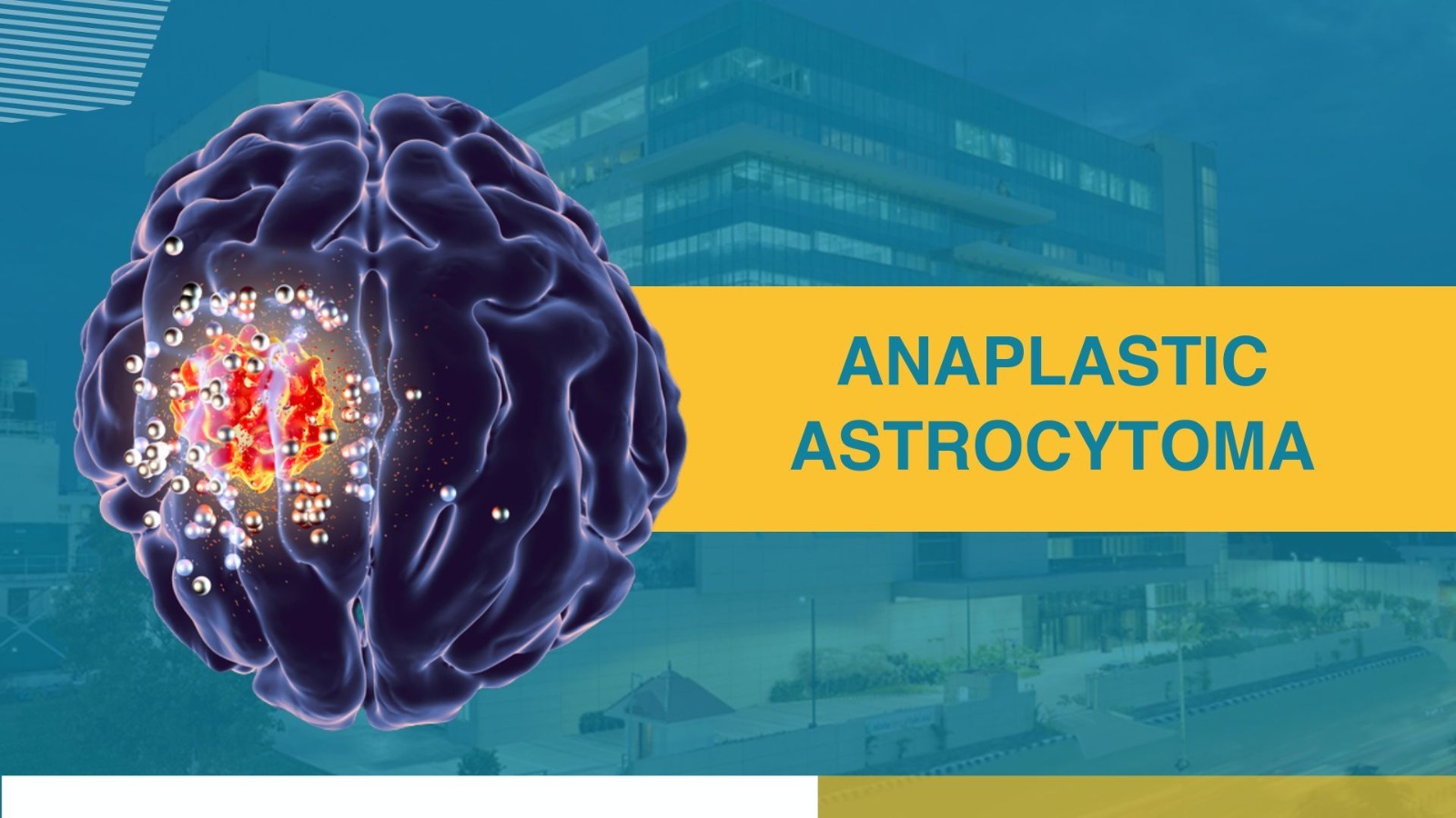 Anaplastic Astrocytoma: Understanding This Rare Brain Tumor