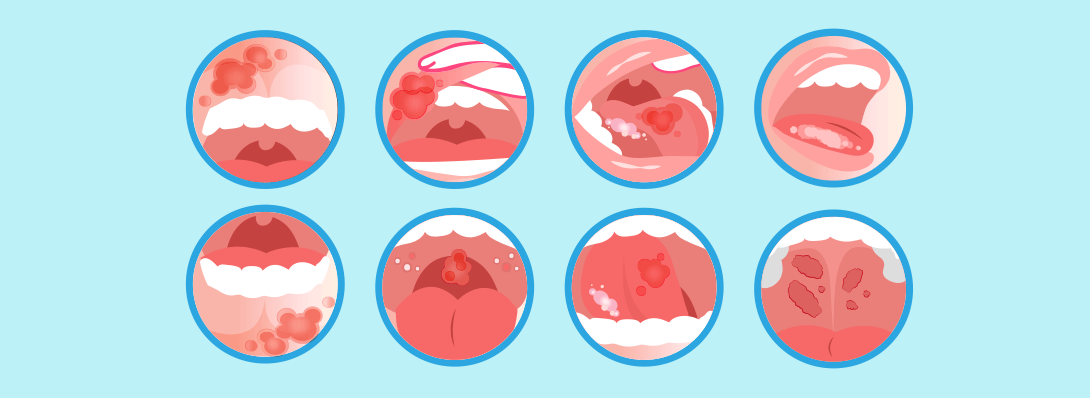 Treatment Options for Oral Cancer by Stage and Type