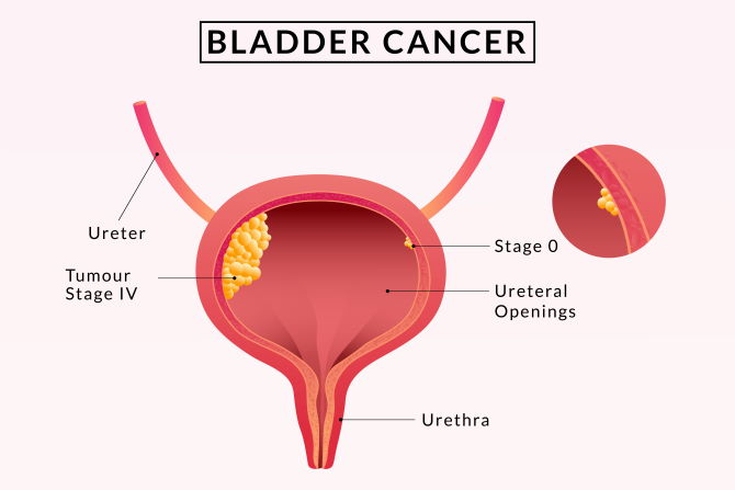 Bladder Cancer in Women vs. Men: Unveiling Distinctive Patterns and Perspectives