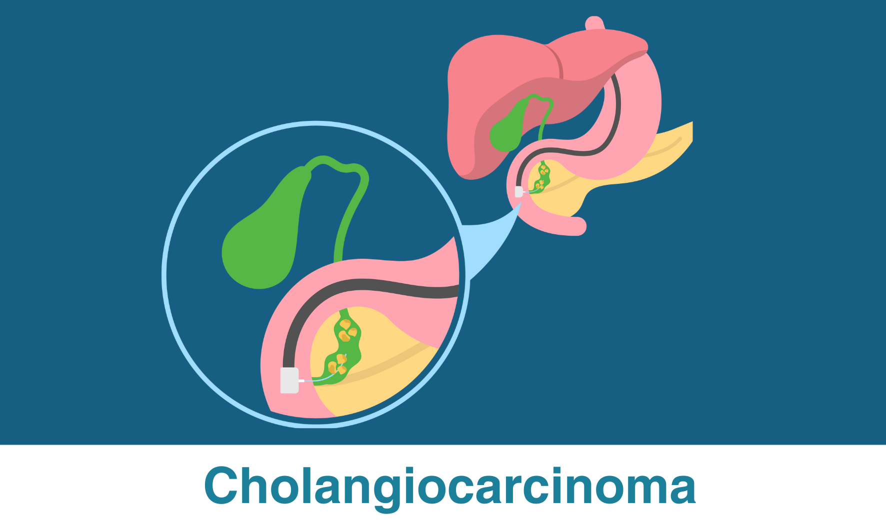 Cholangiocarcinoma