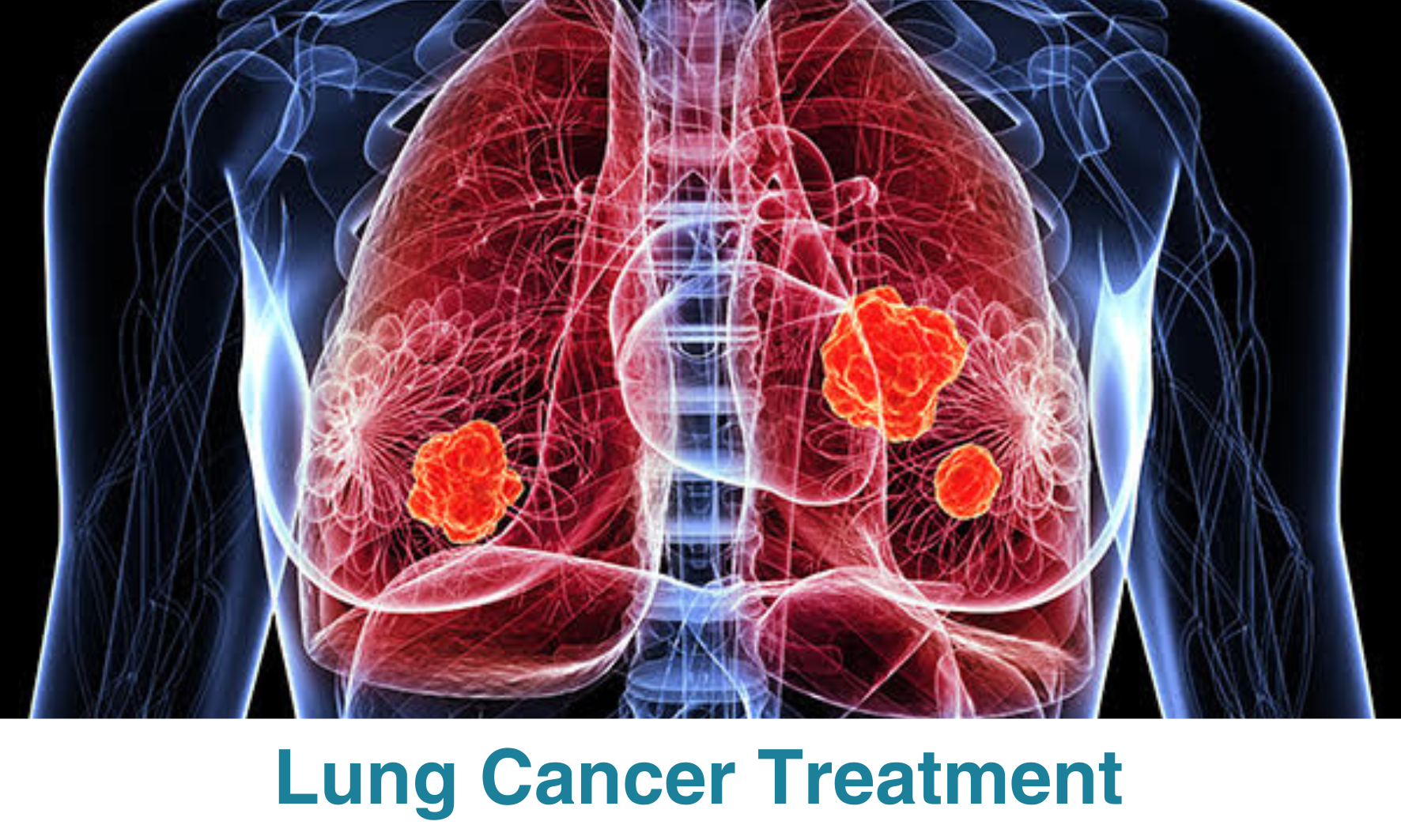 Lung Cancer Treatment
