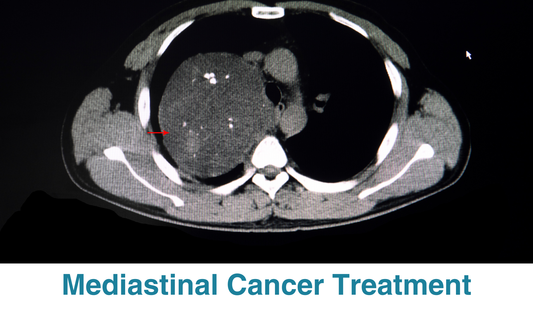 Mediastinal Cancer Treatment