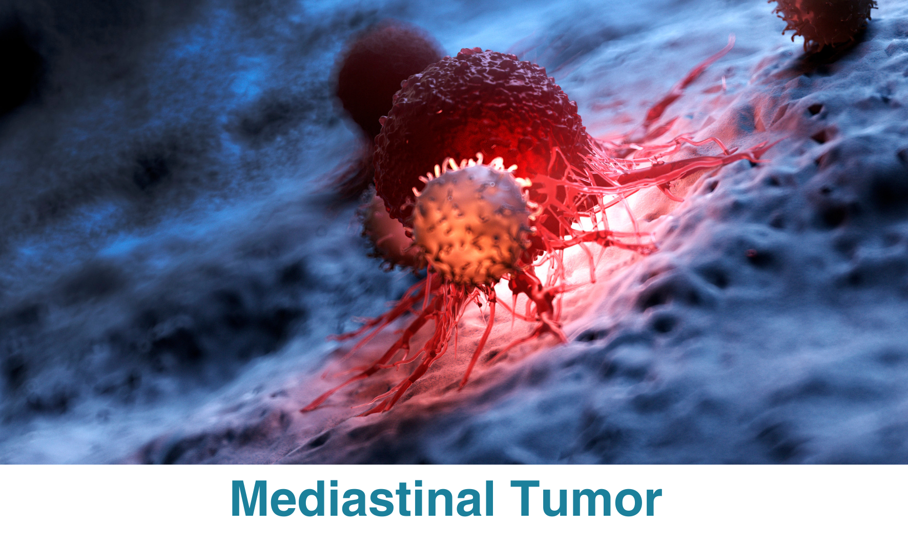Mediastinal Tumor