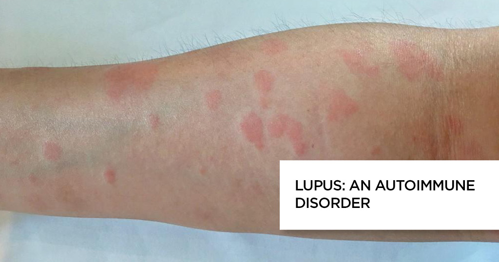 Lupus: An autoimmune disorder Lupus: An autoimmune disorder
