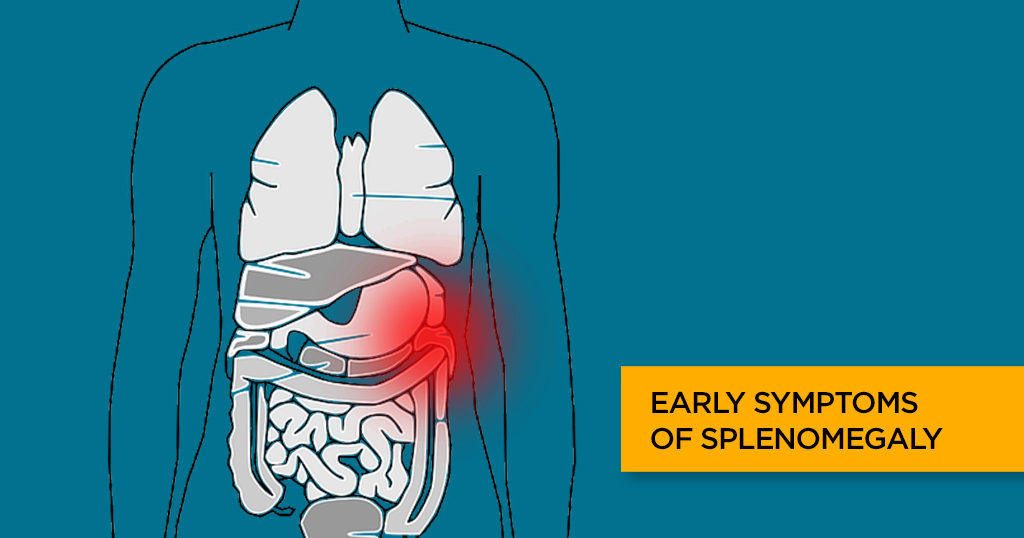 Splenomegaly (Enlarged Spleen): Symptoms, Causes and Treatment