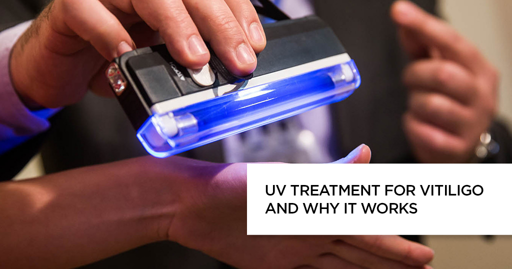 UV Treatment for Vitiligo and Why it Works