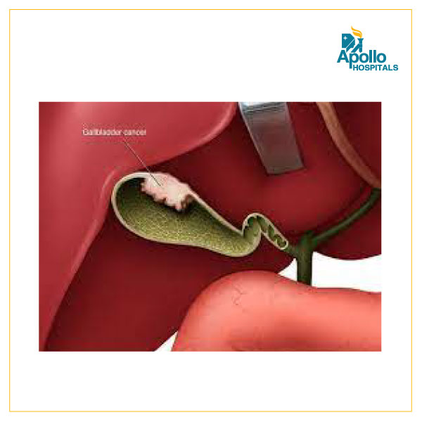 Frequently asked questions about Gallbladder cancer