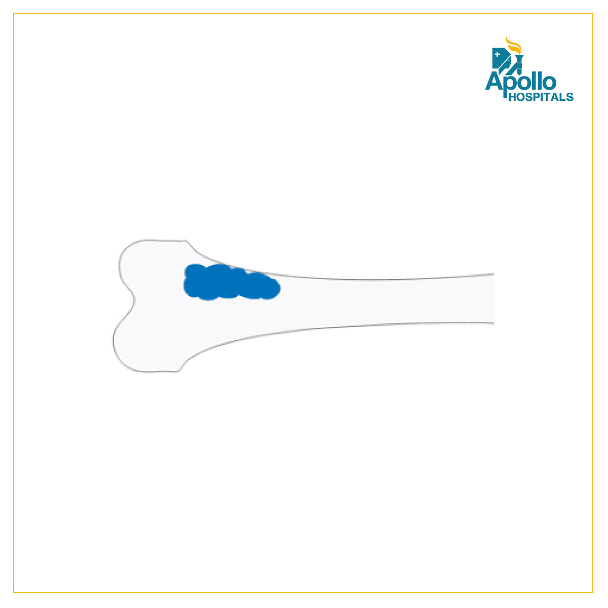 Musculoskeletal Oncology