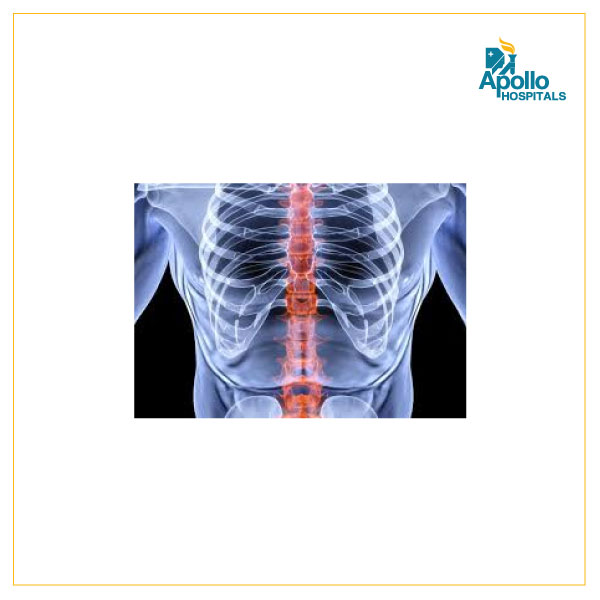 What exactly is Minimal Lower Thoracic Spine Spondylosis?