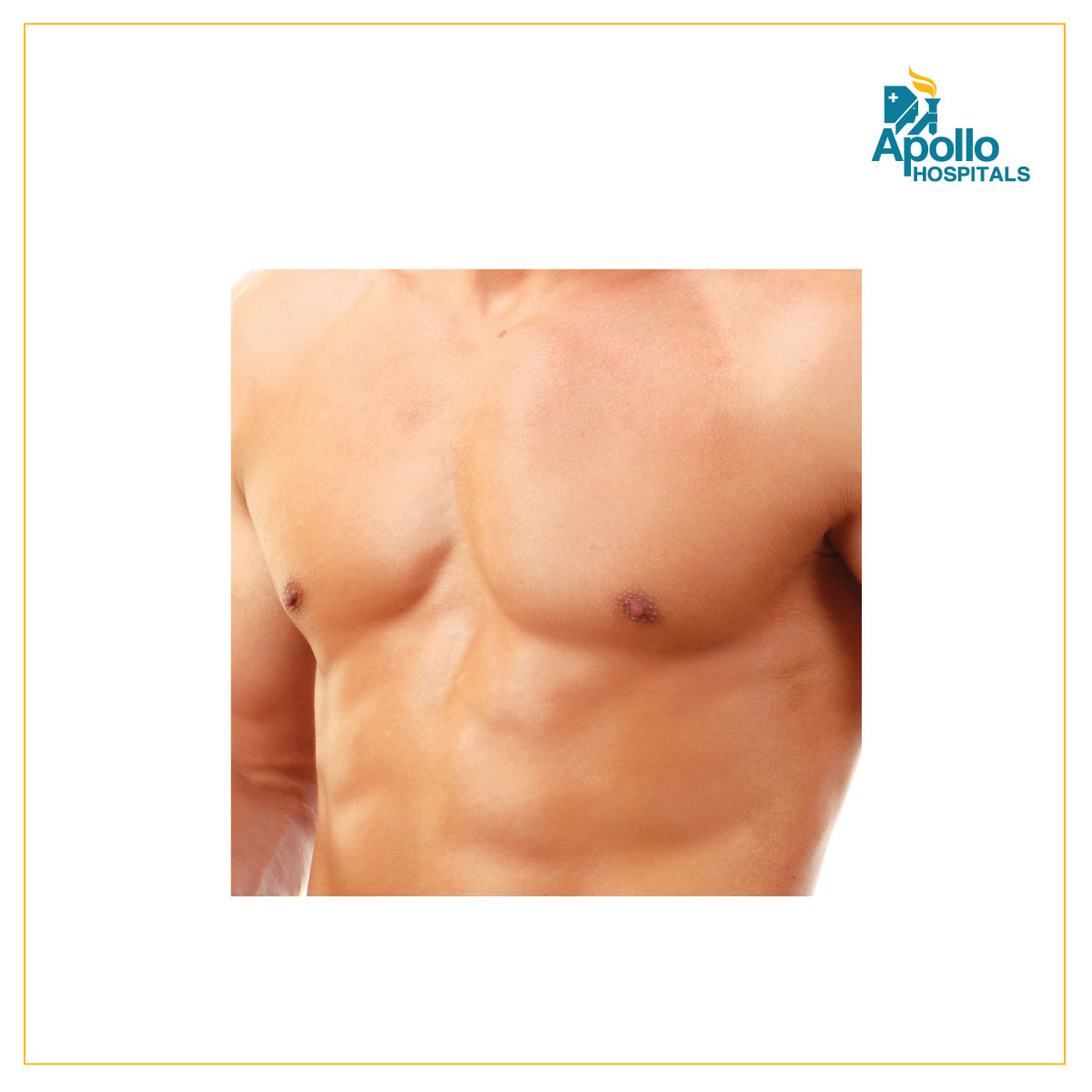 Male Breast Reduction (Gynecomastia)