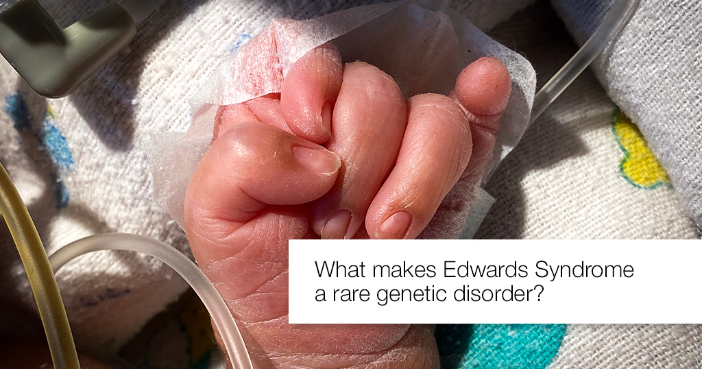 What makes Edwards Syndrome a rare genetic disorder