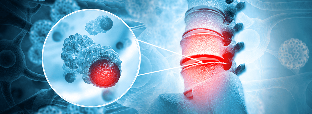Pediatric Sarcoma and Bone Cancer: Unique Challenges and Treatment Approaches
