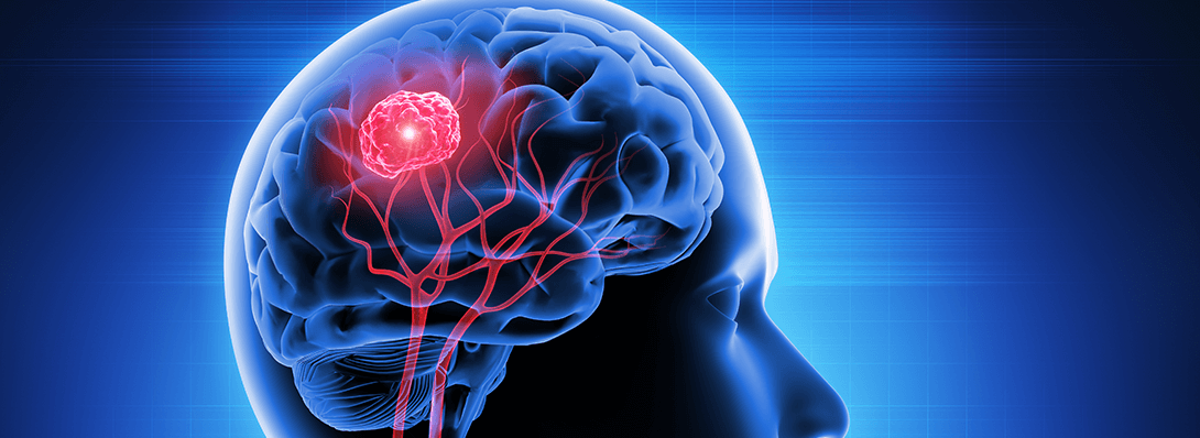 How Surgery Helps People with Brain Tumors and Epilepsy