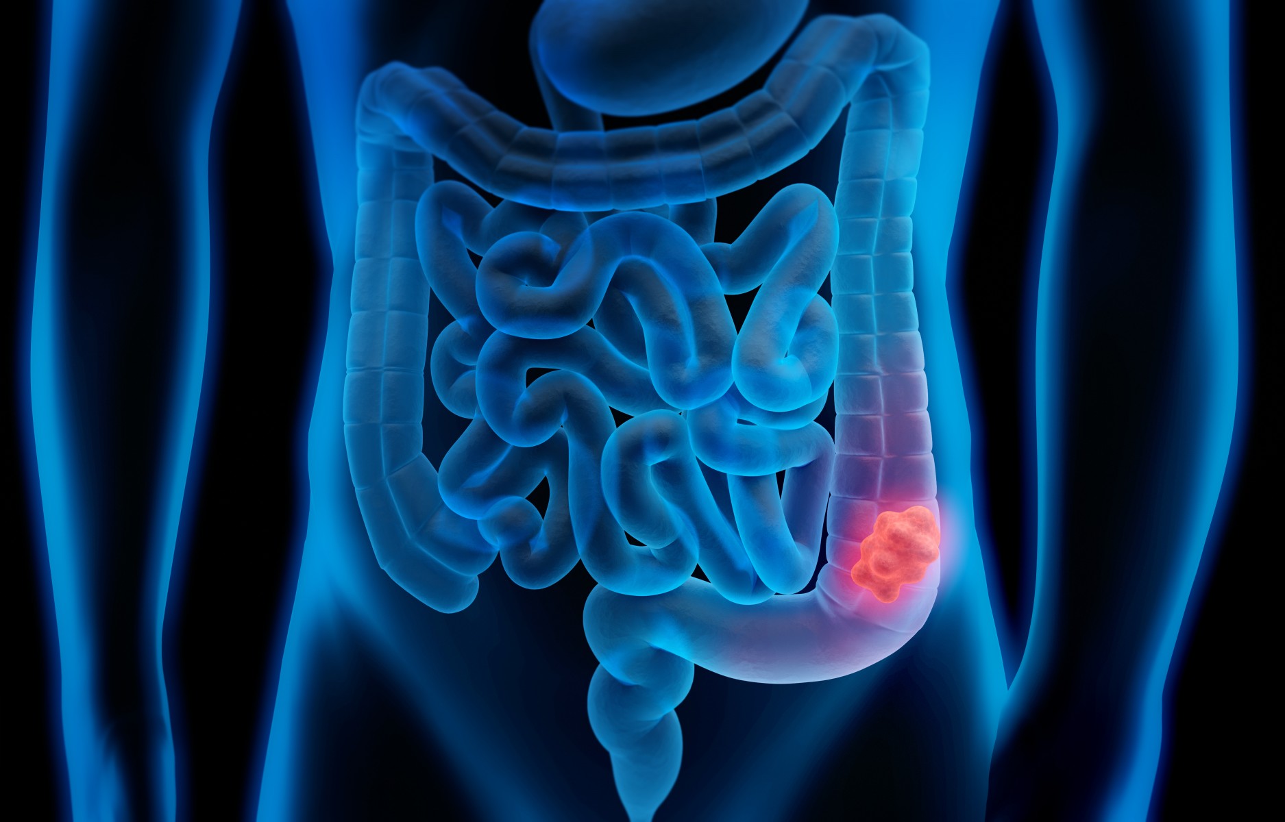 Colon-Cancer