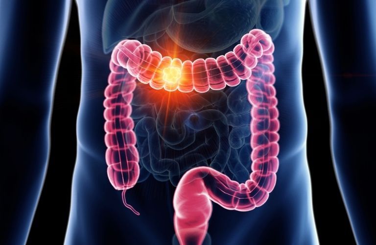 Understanding the Risk Factors of Colorectal Cancer