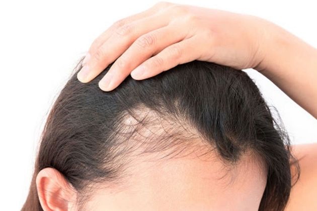 Things to Keep in Mind About Female Pattern Baldness