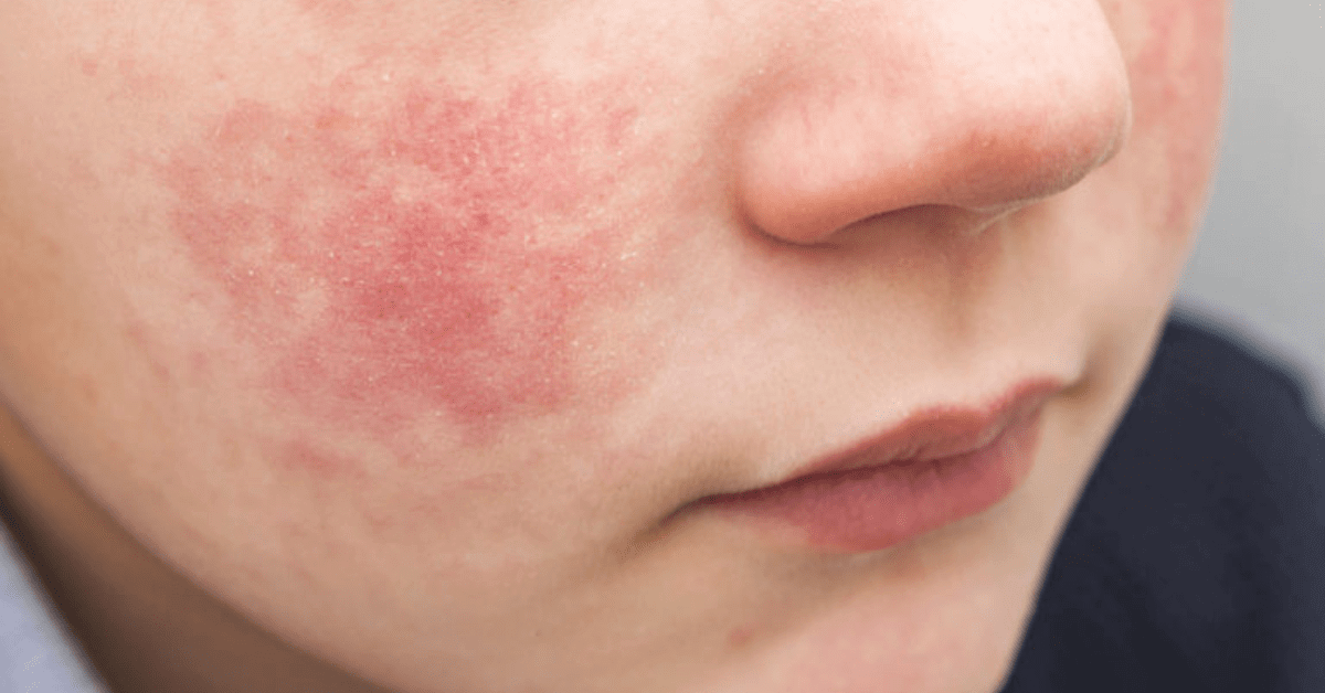 Everything You Need to Know About Fifth Disease