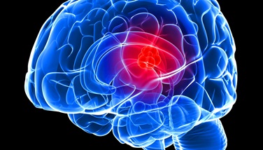 Early Warning Signs of Glioblastoma: Recognizing Symptoms and Seeking Timely  Diagnosis