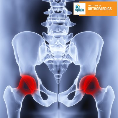 वृद्धावस्था में कूलह ( हिप) के फ्रैक्चर का इलाज