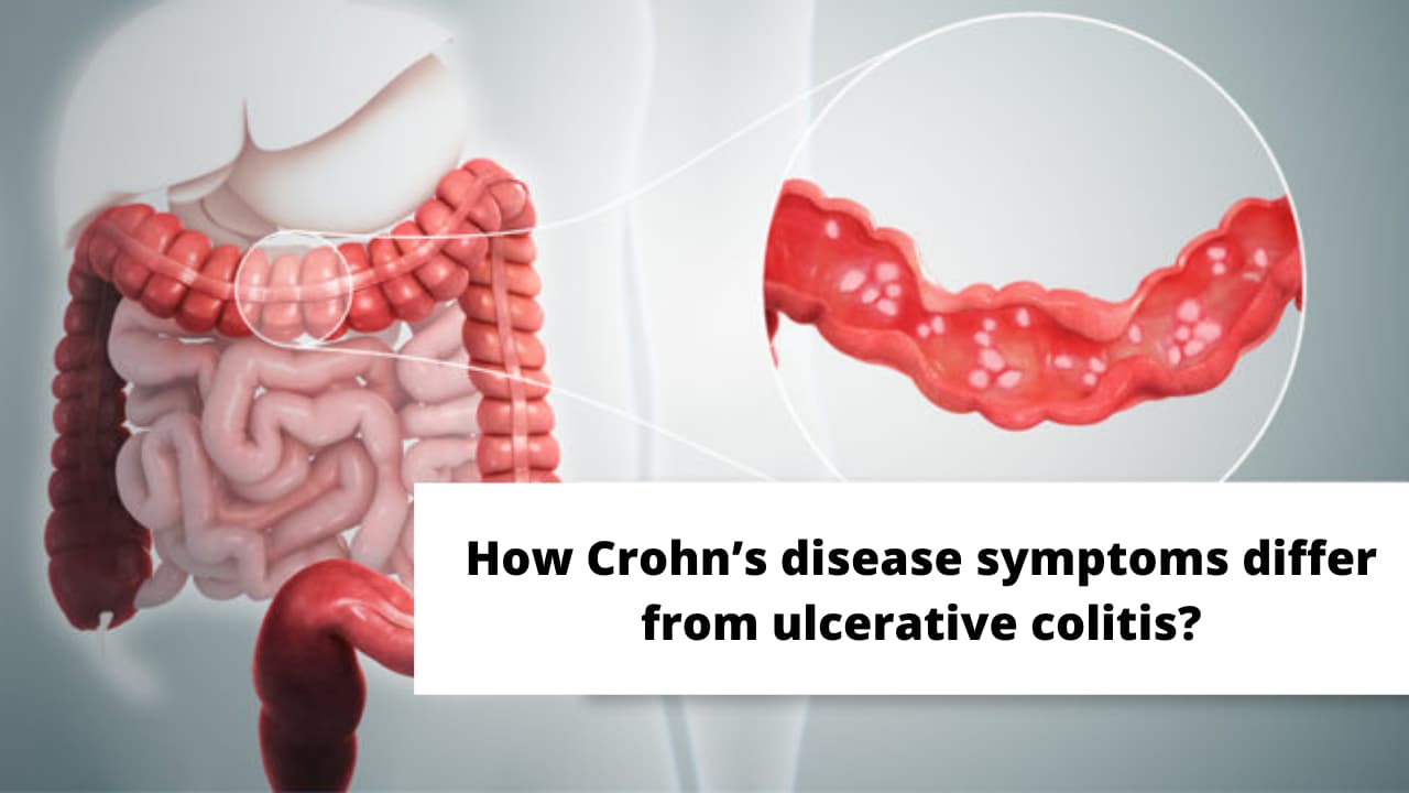 How Crohn’s disease symptoms differ from ulcerative colitis?