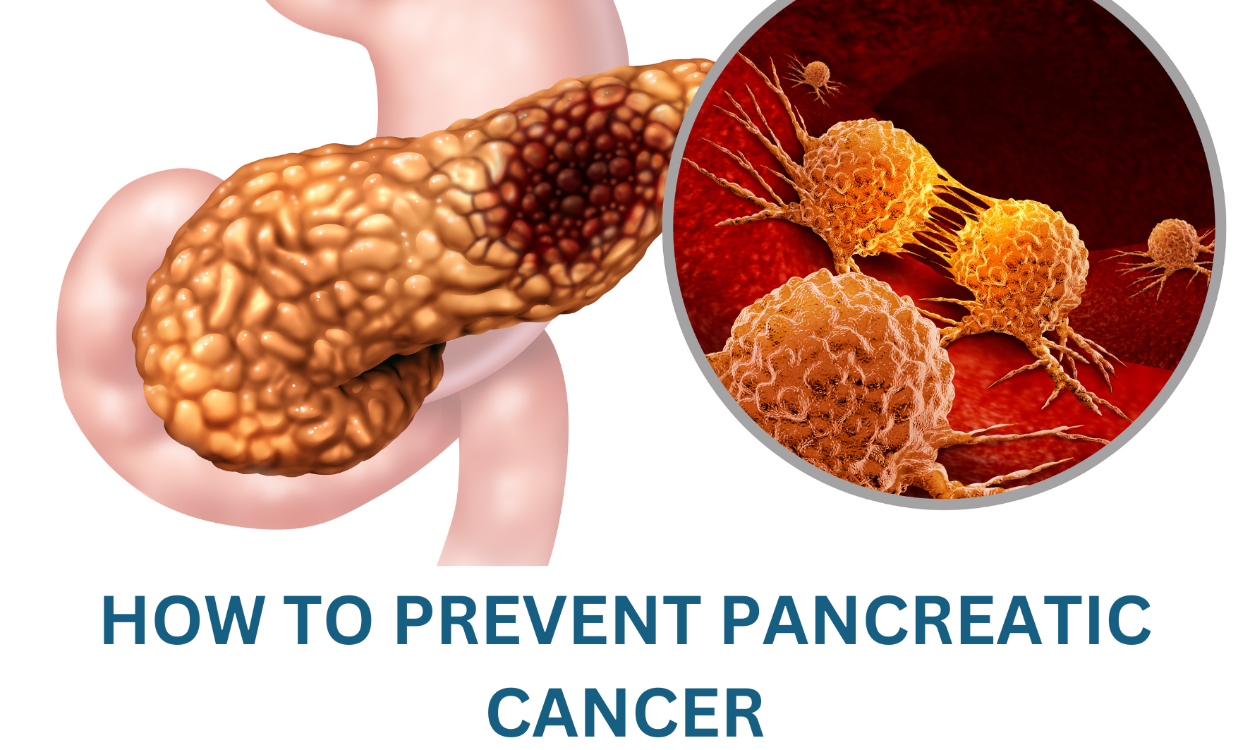 How to prevent Pancreatic Cancer