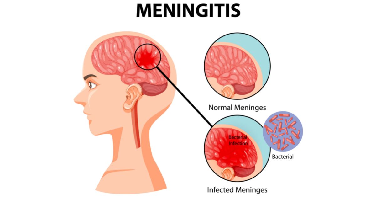 Cryptococcal Meningitis: Symptoms, Causes and Treatment