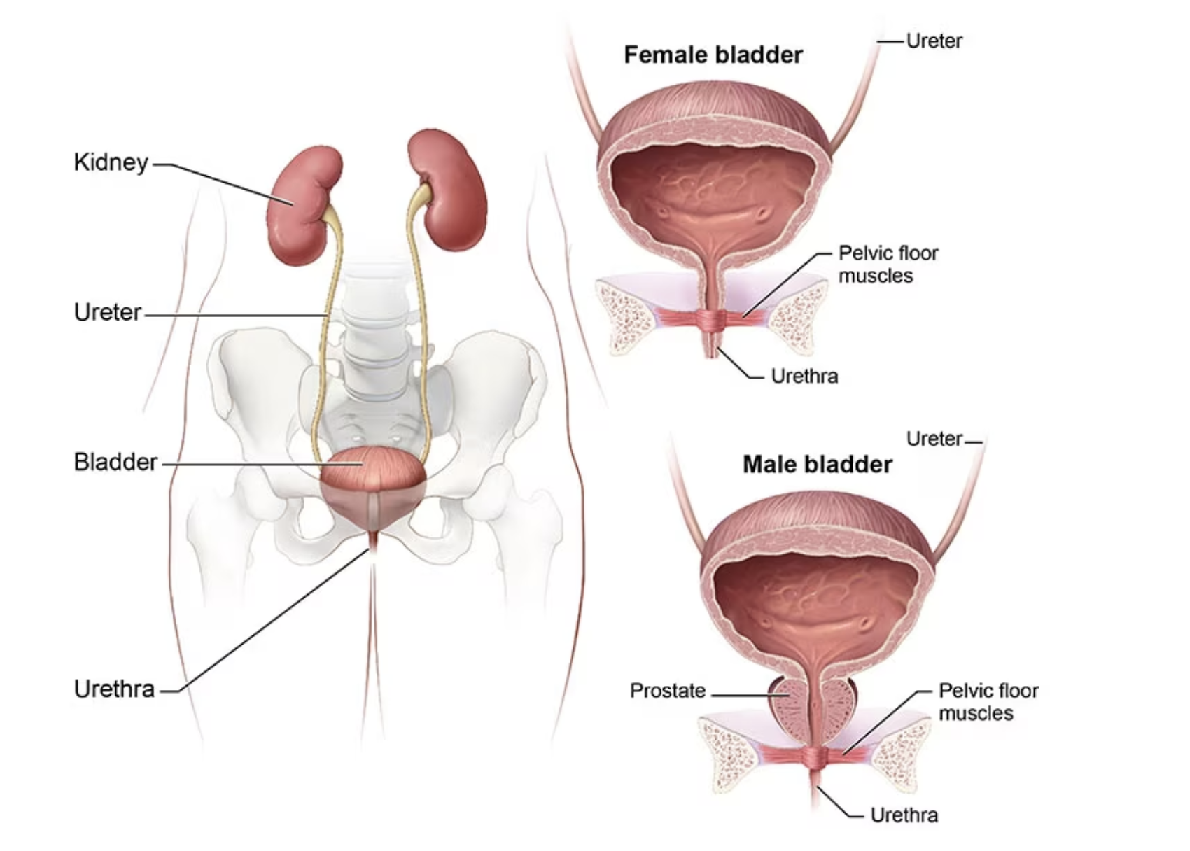 Interstitial cystitis