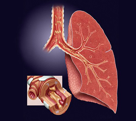 Chronic Bronchitis and COPD – Causes, Signs and Treatment Chronic Bronchitis and COPD – Causes, Signs and Treatment