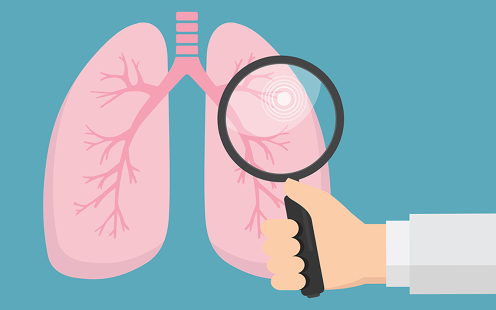 Lung-Cancer-Screening Lung-Cancer-Screening