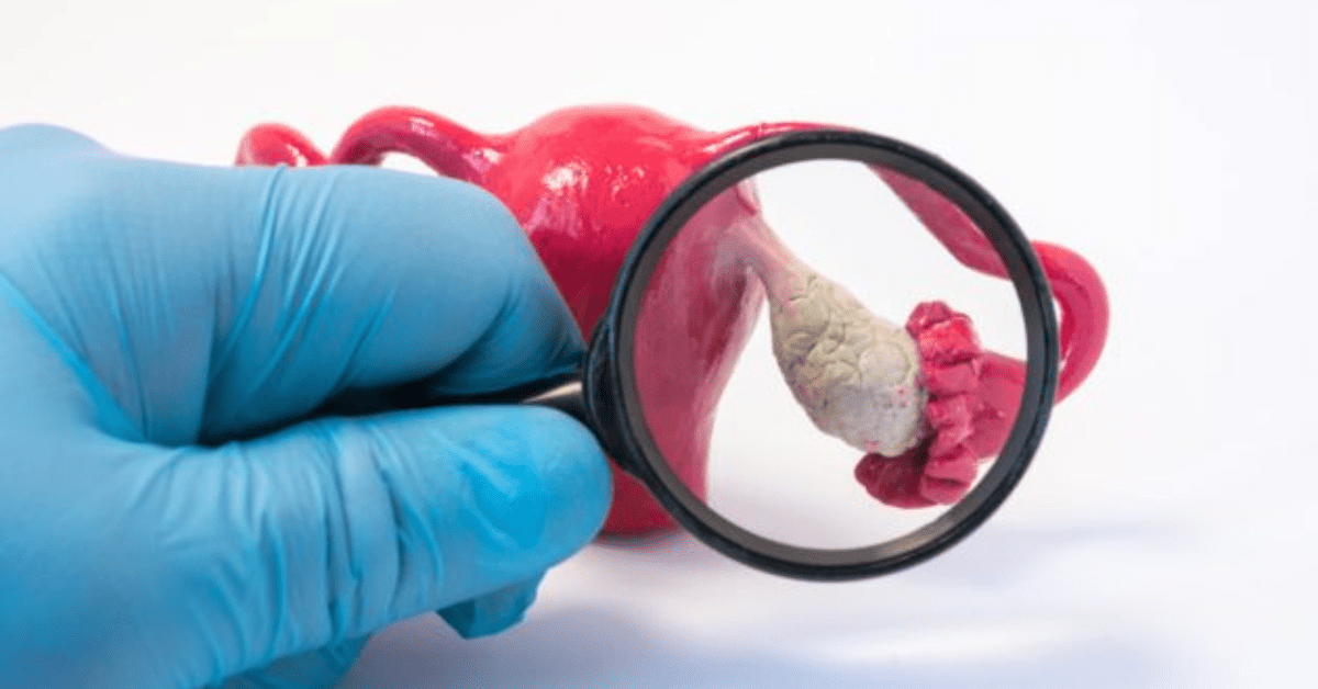 Ovarian Hyperstimulation Syndrome – Causes, Symptoms and Treatment