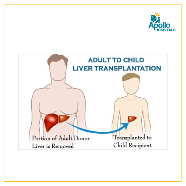 Liver transplant in children: A lifesaving gift