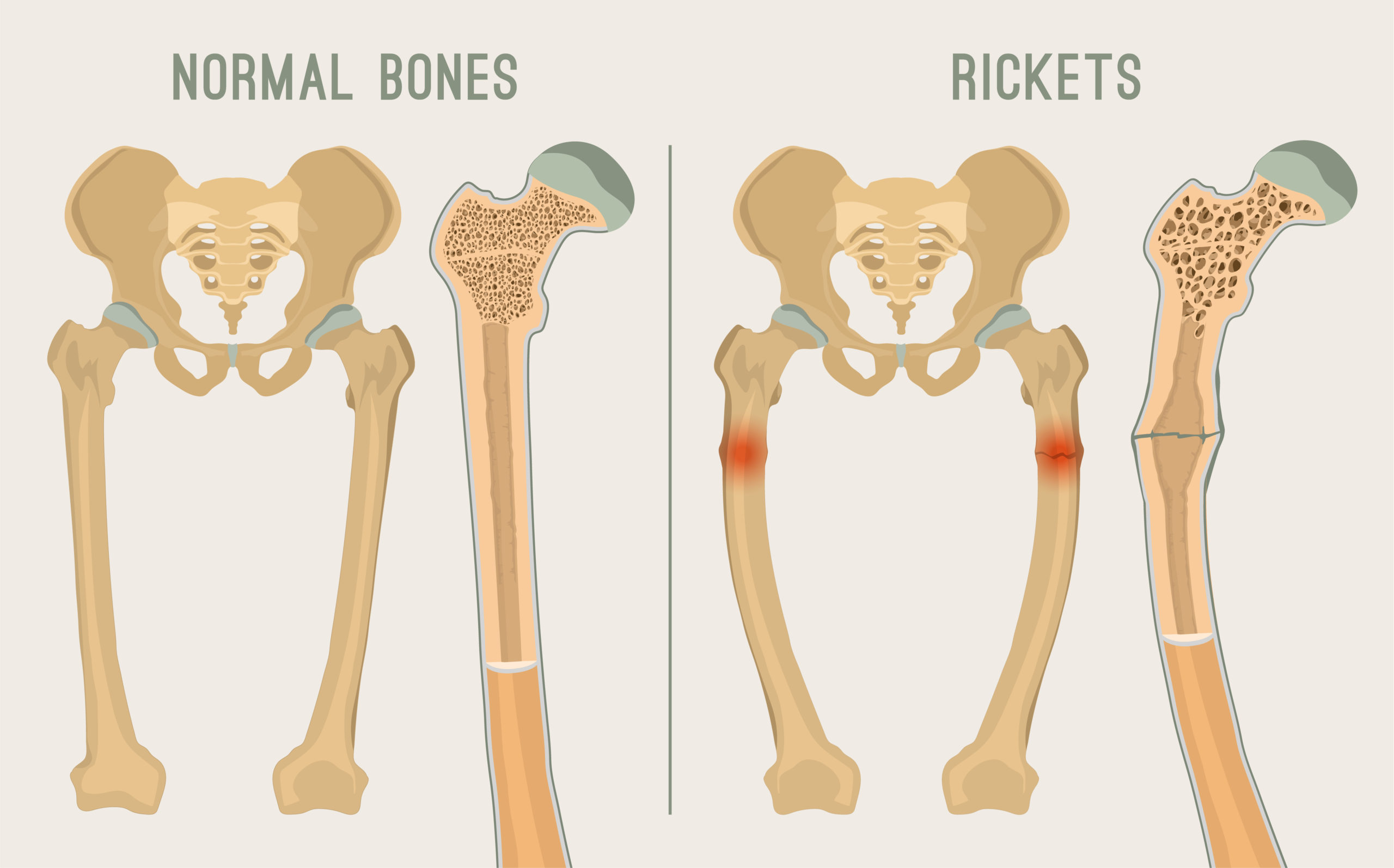 Rickets: All You Wanted to Know