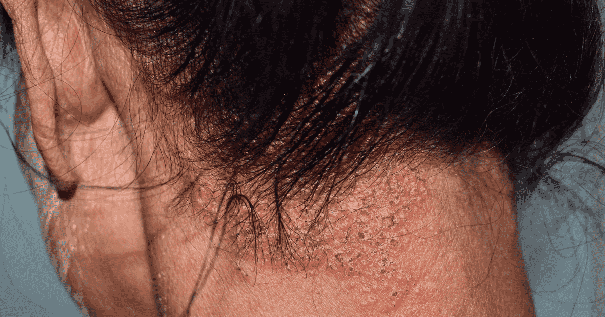 Seborrheic Dermatitis – Types, Causes, Symptoms and Treatment