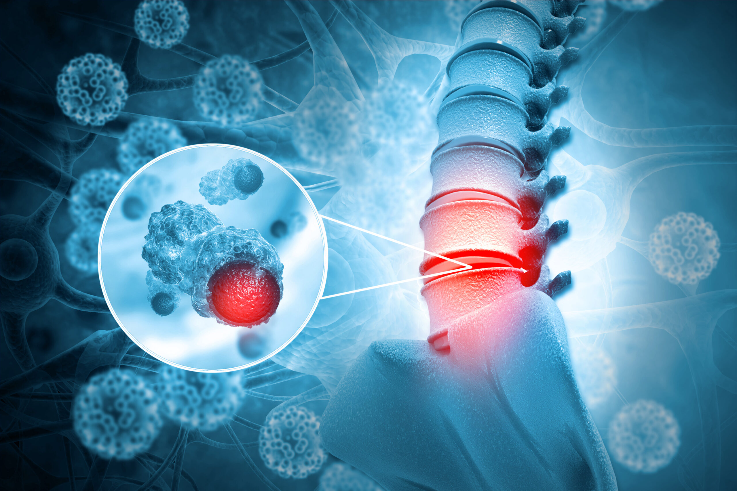 Types of Spine Tumor Treatment: What You Should Know
