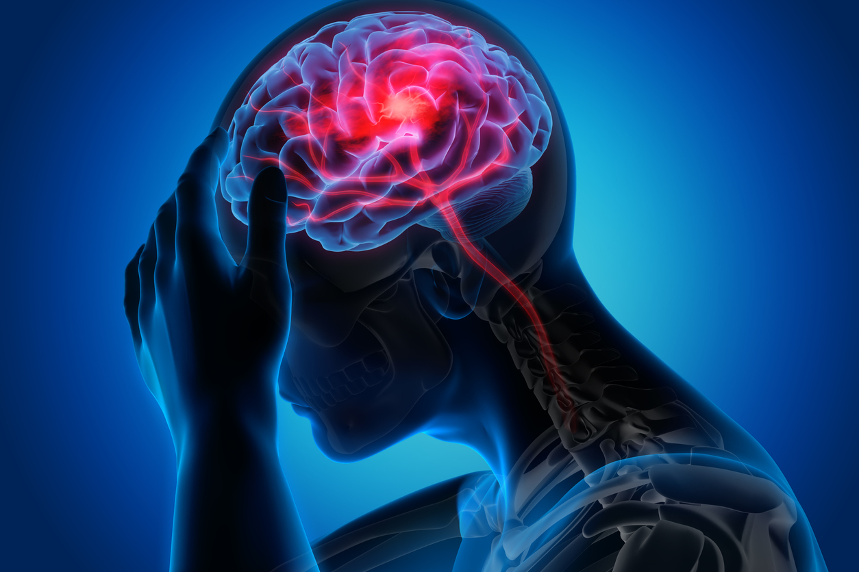 Surgical Management for Stroke: Types, Causes, Symptoms, and Treatment