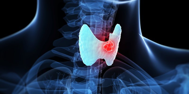 Is Thyroid Cancer in Women More Common?