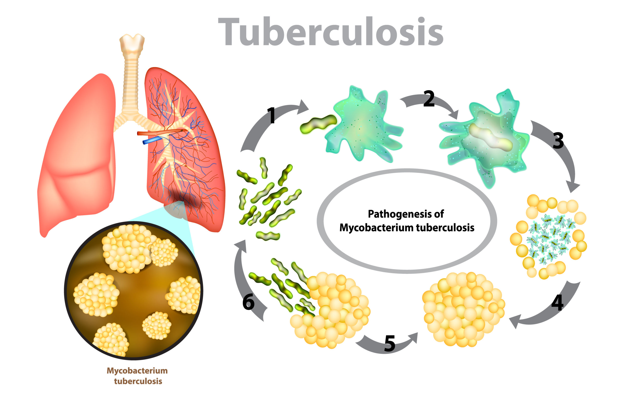Lifestyle Changes to Treat Tuberculosis at Home