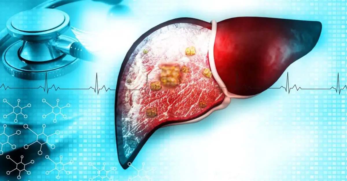 Treatment Options for Liver Cancer: From Chemotherapy to Targeted Therapy