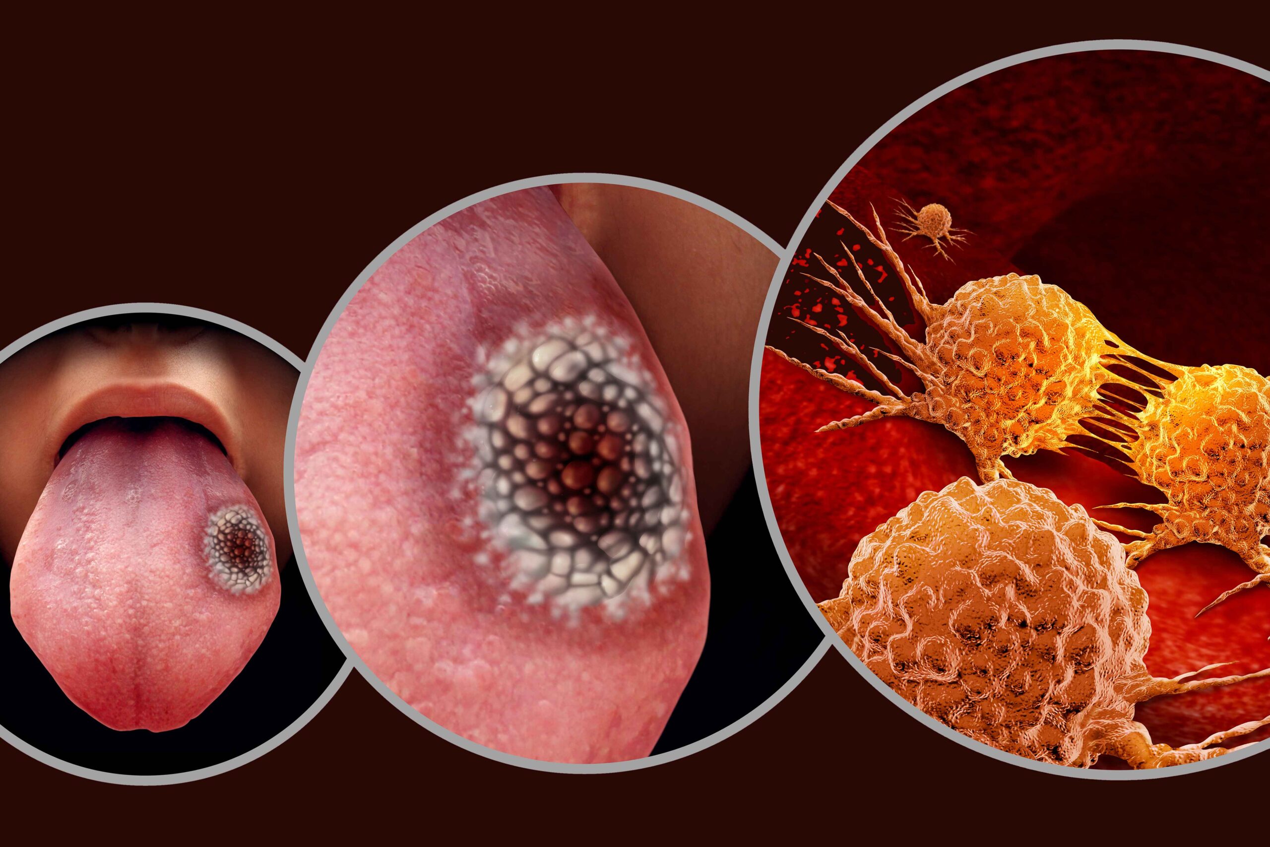 Types of Oral Cancer: What You Need to Know