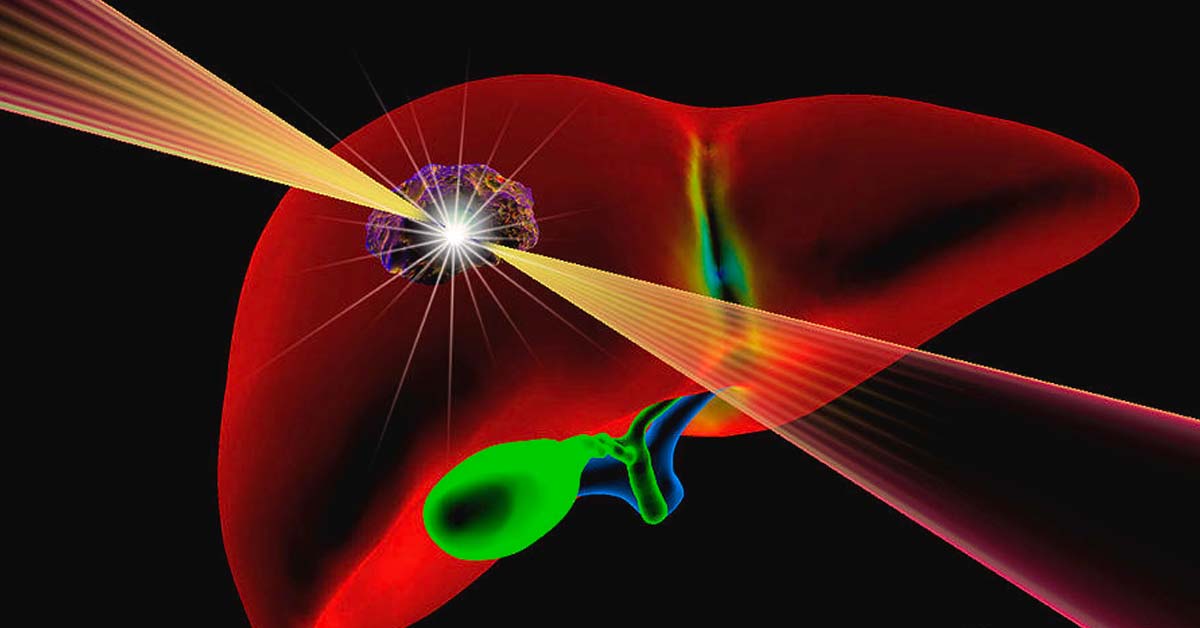 Understanding the Role of Radiation Therapy in Liver Cancer: An Overview