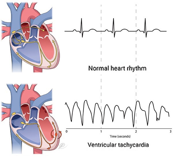 Ventricular Tachycardia- Causes, Symptoms and Treatment