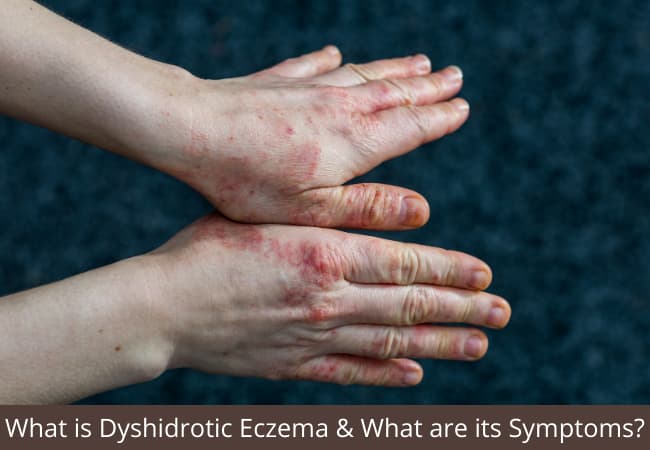 What is Dyshidrotic Eczema &amp; What are its Symptoms?
