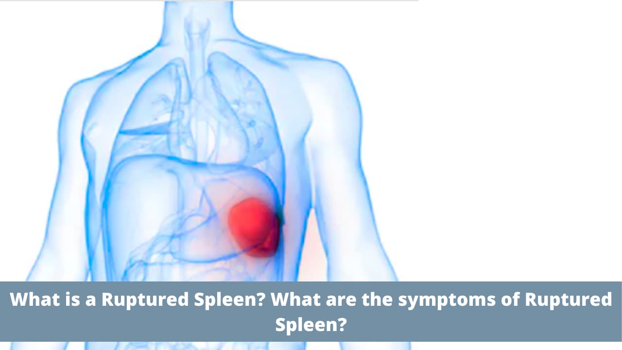 Ruptured Spleen: Symptoms, Causes, Treatment, and Recovery