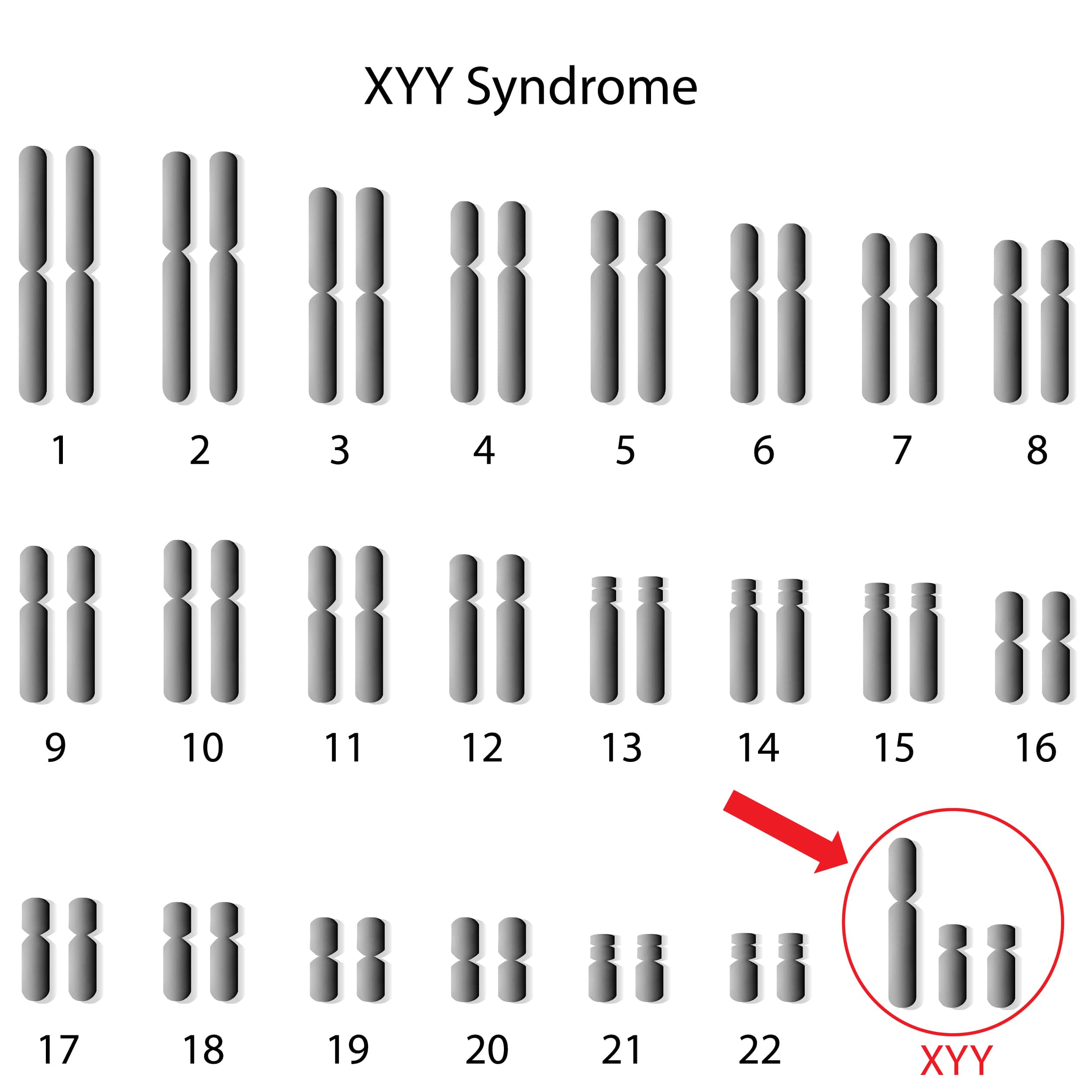XYY Syndrome &#8211; Causes, Symptoms and Treatment