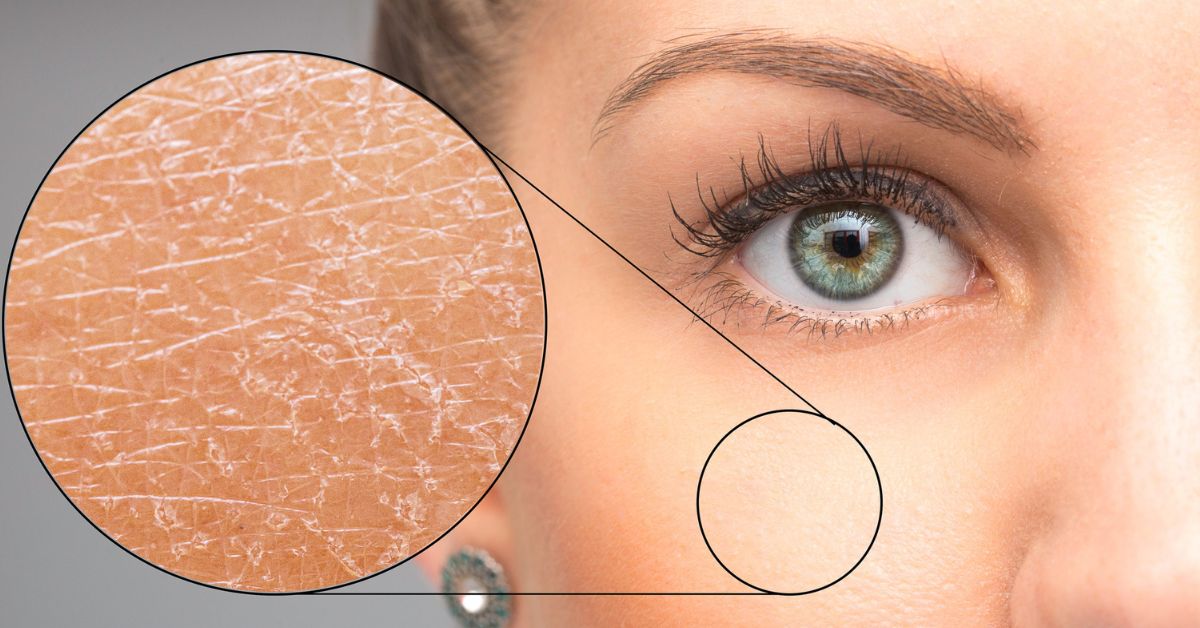 Xeroderma Pigmentosum &#8211; Symptoms, Causes, and Home Remedies
