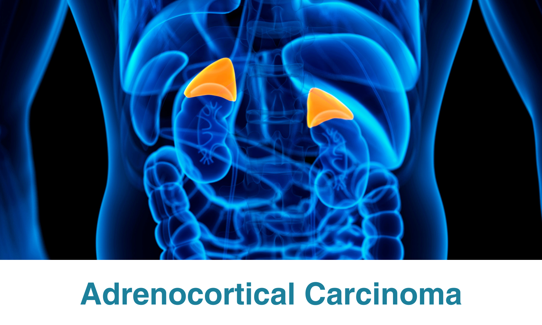 Adrenocortical Carcinoma