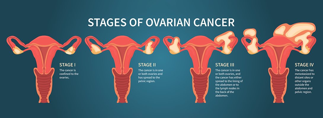 Ovarian Cancer – Everything you need to know about it